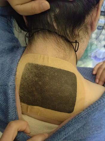 Pain-Relieving Acupoint Patches